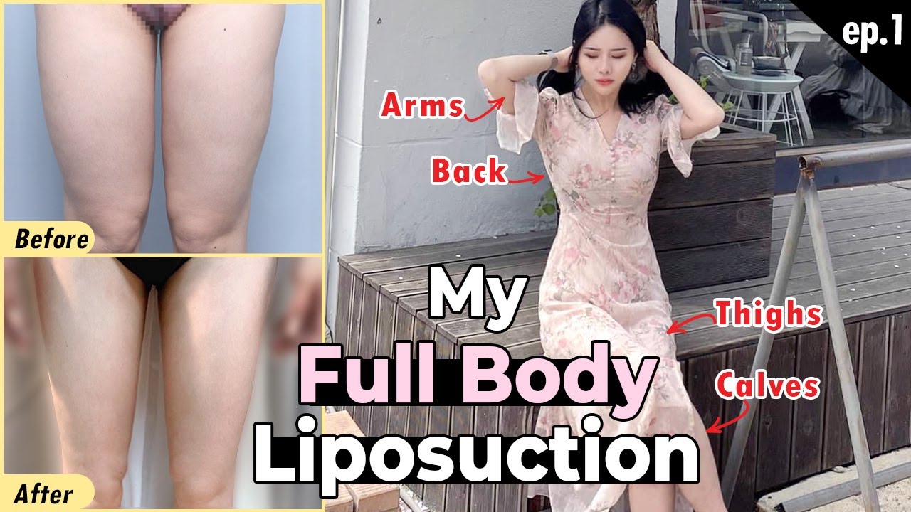 SUB] My Full Body Liposuction Experience in Korean Clinic