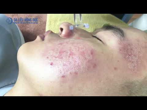[Cận cảnh] Điều trị sẹo lõm bằng Laser vi điểm - Da Liễu Hồng Đức
