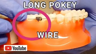 Broken Braces Long, Poking Wire Digging Into Cheek What To Do