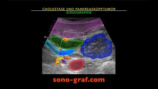 Sonographie - Cholestase Und Pankreaskopftumor