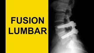 Fusión a espinal de pierna posterior la dolor