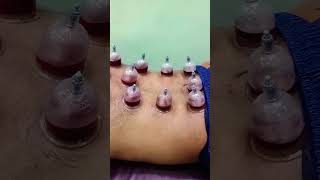 Cholestrol reduce for Cupping Therapy cholestrolfatloss cupping
