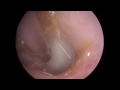 Hidden Ear Wax Removal from Inferior Recess - #478