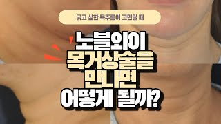 김창연원장이 집도하는 목주름 수술 효과는?(★더보기란 필독★)