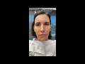 Pdo thread face lift by drtsay  ageless md
