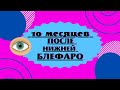 10 месяцев после повторной блефаропластики нижних век.