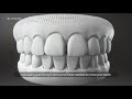 How Does Invisalign Straighten Teeth?