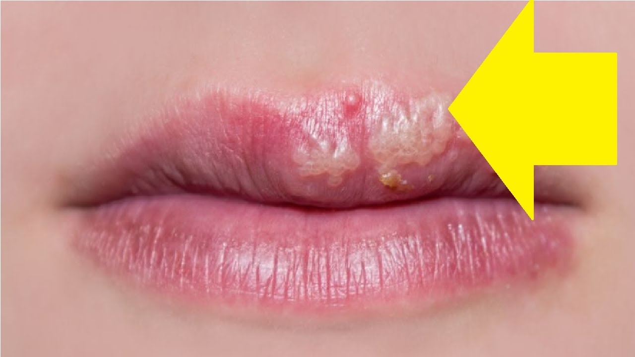 How To Get Rid Of A Cold Sore On Your Lip Overnight Fast Youtube
