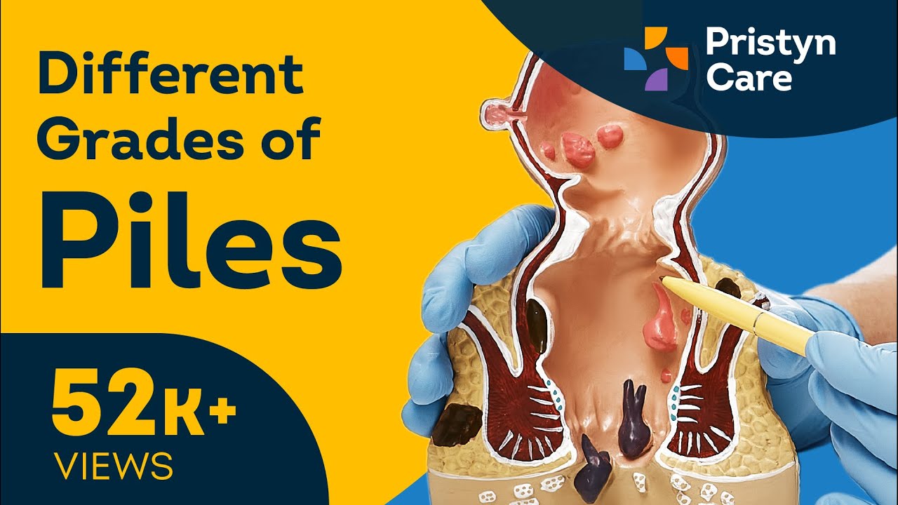 What is Piles | Different Grades of Piles | Best Treatment for Piles in