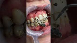 Deep Cleaning Years of Hard Black Tartar – Satisfying 🦷✨ #shorts #teethcleaning  #dentalcare