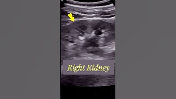 Tracing the Large - Obstructed  Ureteric stone  | Ultrasound