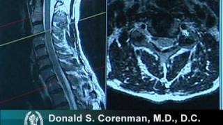 How to Read a MRI of Cervical Nerve Compression | Neck Pain | Colorado Spine Surgeon screenshot 4