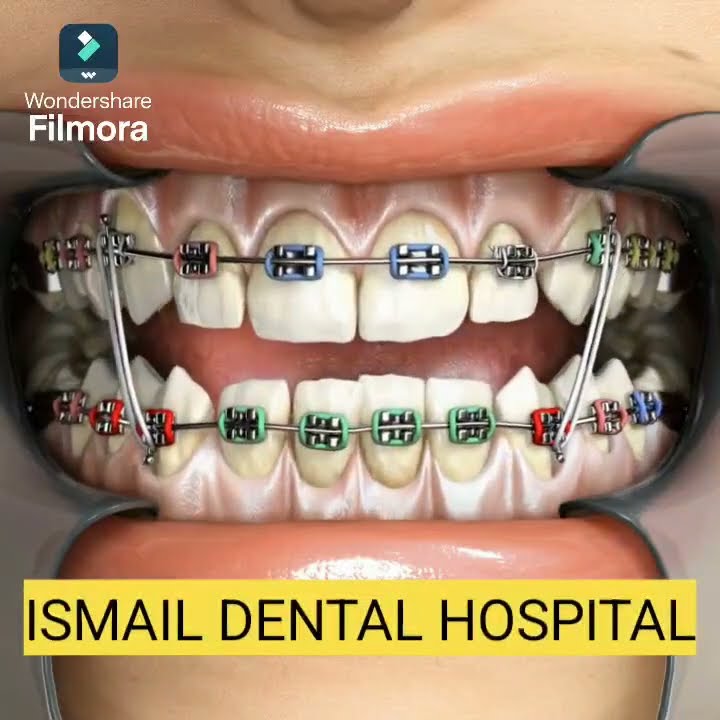 Orthodontic treatment #dentalcaries #dentist #orthodontist #dentalfilling #healthysmile #doctor