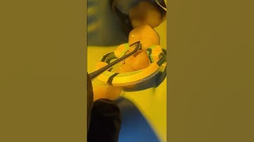 Class 2 restoration with Garrison Dental Rings ✨