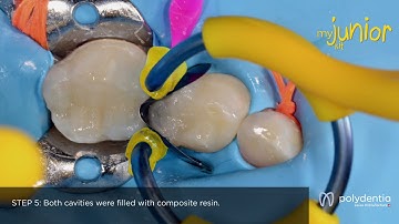 Restoration of a primary molar with myClip Junior. Clinical Case by Dr. Marina Papachroni