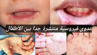 مرض فيروسي منتشر جدا بين الأطفال(كل ما يخص داء اليد والقدم والفم)