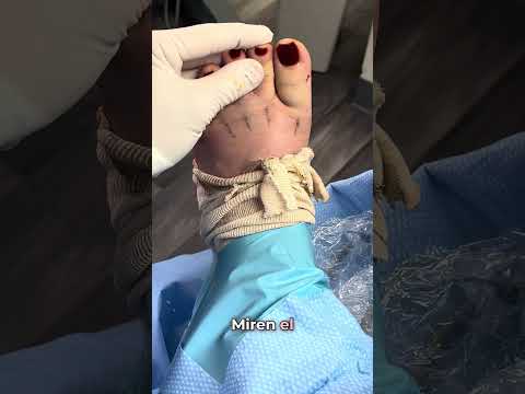 JOIN ME IN THE OPERATING ROOM!💉👠#shorts #toeshortening #toeshorteningsurgery