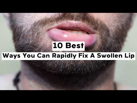 10-best-ways-you-can-rapidly-fix-a-swollen-lip