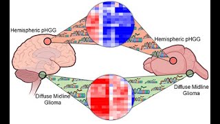 Platelet-Derived Growth Factor Beta Is A Potent Inflammatory Driver In Paediatric High-Grade Glioma