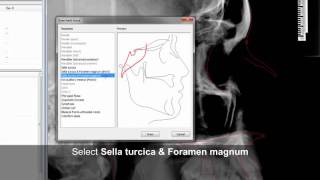 Draw other hard tissue (#5) with Facad software