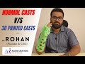 Normal Casts v/s 3D Printed Casts | Addere Creations