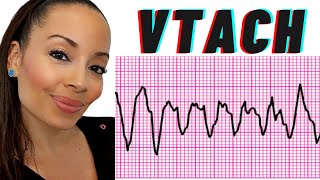 Ventricular Tachycardia  (VTACH) ECG Interpretation, Causes, Treatment, Nursing NCLEX Review