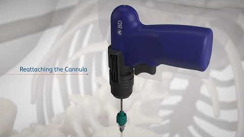 BD Trek™ Powered Bone Biopsy System: Bone Lesion Procedural Video