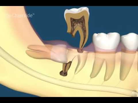 Как выпиливают зуб мудрости