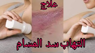 وصفه طبيعيه لعلاج التهابات تحت الابط بسبب موزيل العرق