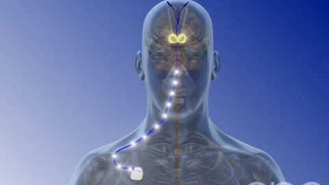 Deep Brain Stimulation - 3D Medical Animation || ABP ©