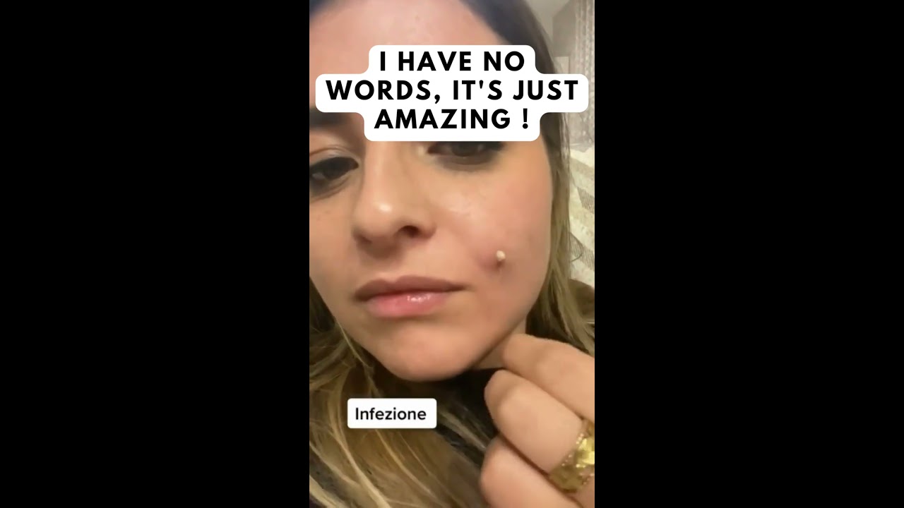 Never Squeeze Acne With Your Hands 