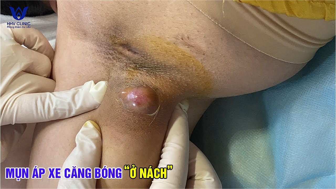 “Tưởng chỉ là mụn thường – ai ngờ chuyển nặng thành ổ áp xe lớn”