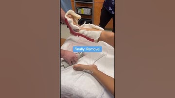 Removing a cast in 4 easy steps! | Boston Children