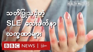 သတိပြုသင့်တဲ့ SLE လေးဖက်နာ လက္ခဏာများ - BBC News မြန်မာ