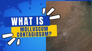 What is molluscum contagiosum?