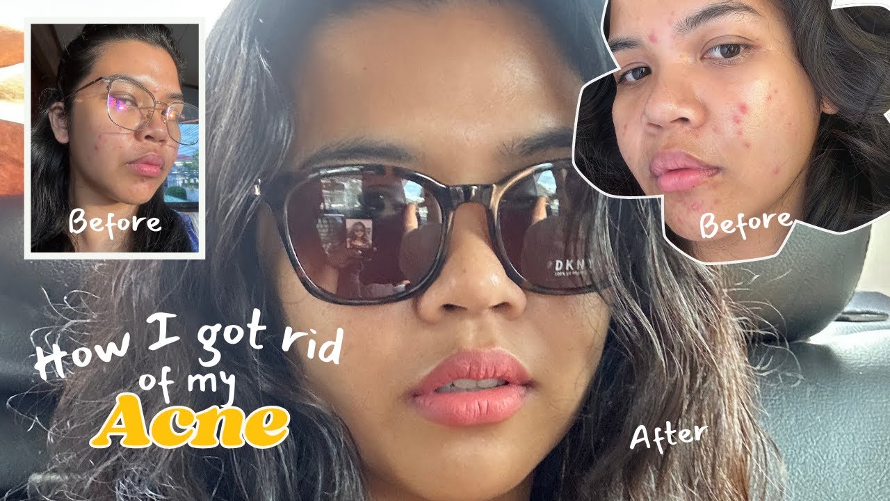 How I got rid of my acne: My Acne Finally Cleared… Here’s What Actually ...
