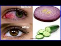 Best way to improve your eyesight naturally with Cucumber Onion / Eye treatment at home in 5 days