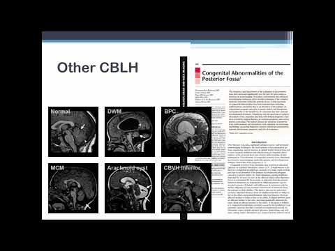E13.2 Defects of the cerebellum