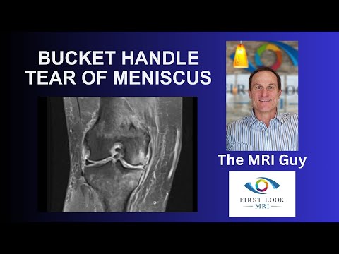 Bucket handle tear