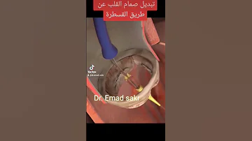 تبديل صمام القلب عن طريق القسطرة Reemplazo De Válvula Cardíaca Transcatéter 