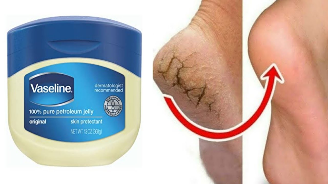 3 WAYS TO FIGHT CRACKED HEELS IN THE WINTERS