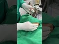 Fat Grafting Procedure [Part 9] | Live Jawline &amp; Chin Augmentation Using Fat Grafting.