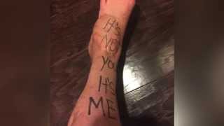 Boston Marathon Survivor Writes Breakup Letter to Her Amputated Leg