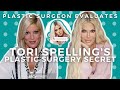 Did Tori Spelling have surgery to look like Khloe Kardashian? Plastic Surgeon evaluates.