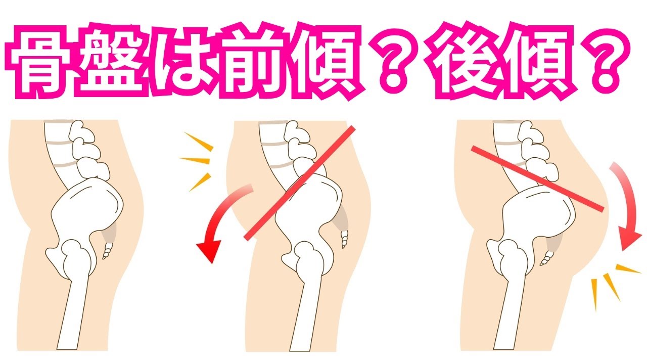 【決定版】「スウェイバック姿勢の骨盤は前傾？後傾？」理学療法士が教える姿勢の解釈！