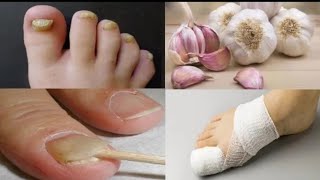 ¿Sufres de hongos en las uñas ¡¡¡¡ Tienes que hacer esto *** CONSEJO MUY IMPORTANTE ***