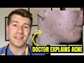 Doctor explains acne symptoms selfcare treatment options and complications