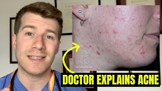 Doctor explains ACNE symptoms, self-care, treatment options and complications...