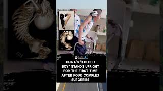 👉CHINA'S "FOLDED BOY" STANDS UPRIGHT FOR THE FIRST TIME AFTER FOUR COMPLEX SURGERIES😱#shorts
