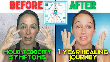 How I FIXED My Mold Toxicity: Symptoms, Testing & the Steps (And You Can Too)